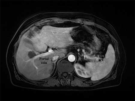 Effective and Safe Treatment of Risky Localized Liver Tumors Using Microwave Ablation in Patients with Comorbid Lung Diseases Unfit for Deep Anesthesia.