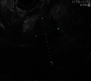 Pancreatic Myeloid Sarcoma Causing Obstructive Jaundice: A Case Report and Literature Review.