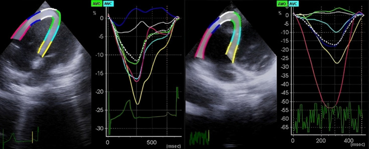 Effects of balloon pulmonary valvuloplasty on longitudinal changes in right ventricular strain and strain rate in pediatric pulmonary stenosis.