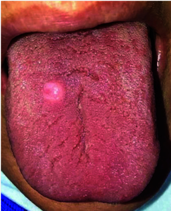 Oral Granular Cell Tumor: A Case Report with Emphasis on Pseudoepitheliomatous Hyperplasia in Oral Lesions.