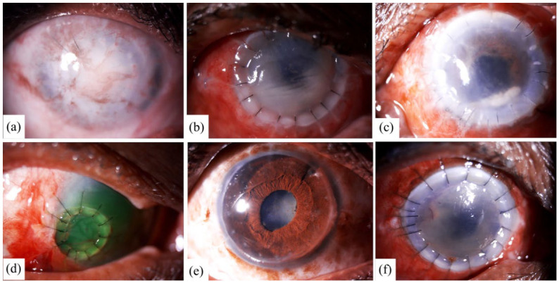 Pediatric corneal transplantation: techniques, challenges, and outcomes.