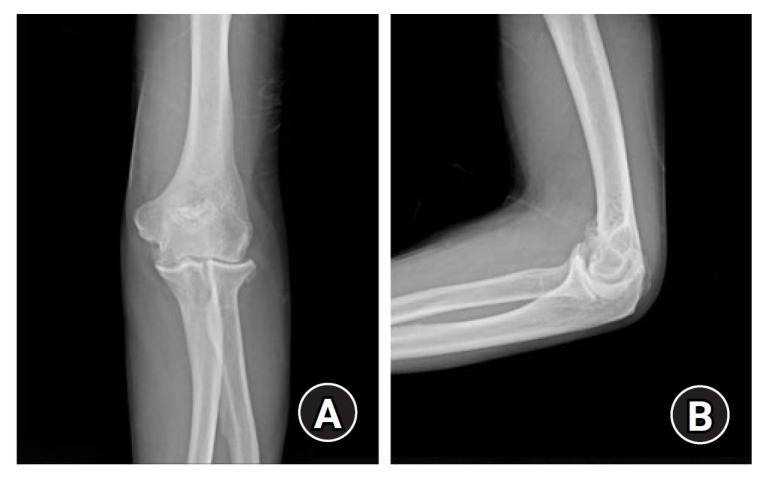 Cubital tunnel syndrome associated with previous ganglion cyst excision in the elbow: a case report.