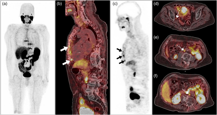 Intense prostate-specific membrane antigen receptor expression in coronary artery pypass graft scar tissue: A potential molecular imaging pitfall.
