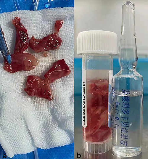 Obstructive Fibrinous Tracheal Pseudomembrane Following Repeated Intratracheal Interventions.