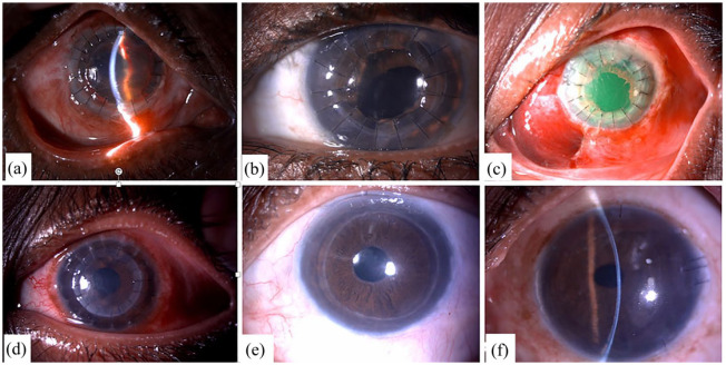 Pediatric corneal transplantation: techniques, challenges, and outcomes.