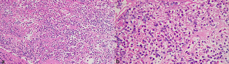 Obstructive Fibrinous Tracheal Pseudomembrane Following Repeated Intratracheal Interventions.
