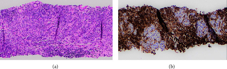 Pancreatic Myeloid Sarcoma Causing Obstructive Jaundice: A Case Report and Literature Review.