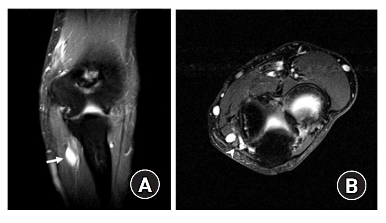Cubital tunnel syndrome associated with previous ganglion cyst excision in the elbow: a case report.