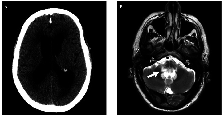[Cryptococcal meningitis associated with hydrocephalus in an immunocompetent patient].