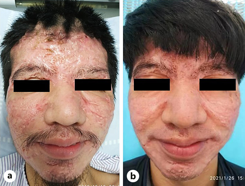 Comprehensive Treatment of a Rare Case of Complete Primary Pachydermoperiostosis with Large Facial Keloid Scars: A Case Report and Literature Review.
