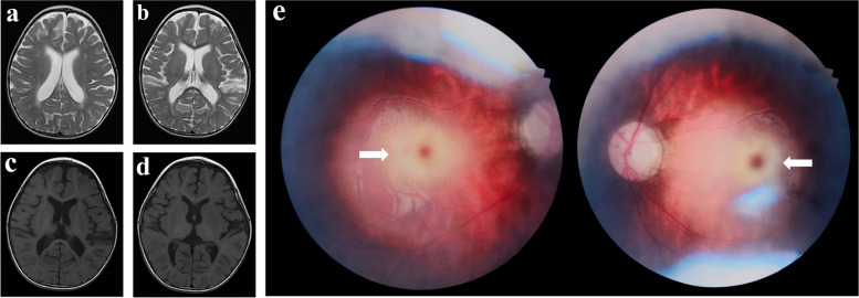 Genetic variant reanalysis reveals a case of Sandhoff disease with onset of infantile epileptic spasm syndrome.