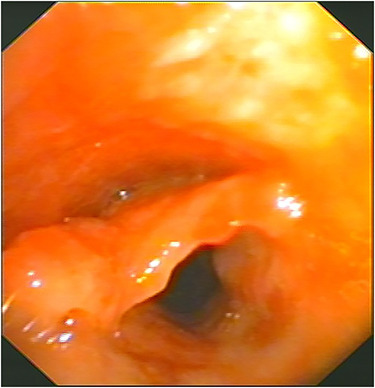 Obstructive Fibrinous Tracheal Pseudomembrane Following Repeated Intratracheal Interventions.
