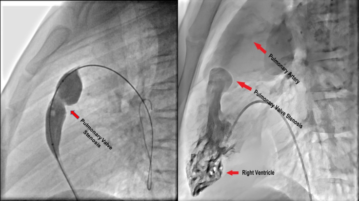 Effects of balloon pulmonary valvuloplasty on longitudinal changes in right ventricular strain and strain rate in pediatric pulmonary stenosis.