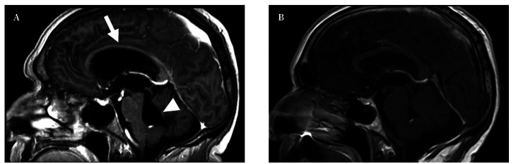 [Cryptococcal meningitis associated with hydrocephalus in an immunocompetent patient].