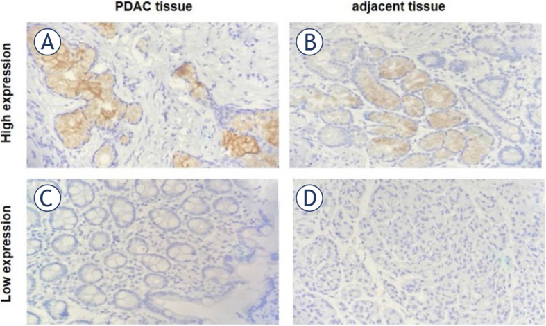 Correlation of laminin subunit alpha 3 expression in pancreatic ductal adenocarcinoma with tumor liver metastasis and survival.