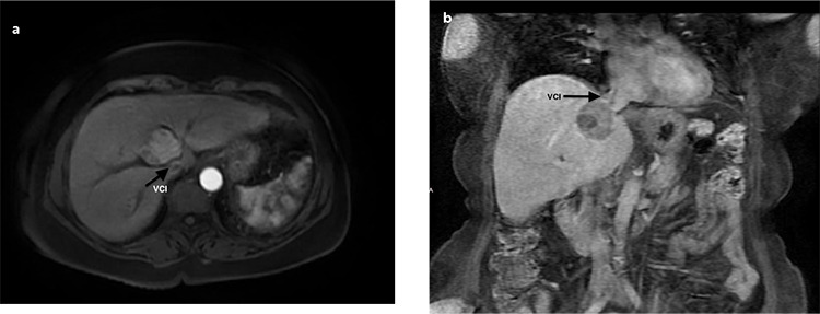 Effective and Safe Treatment of Risky Localized Liver Tumors Using Microwave Ablation in Patients with Comorbid Lung Diseases Unfit for Deep Anesthesia.