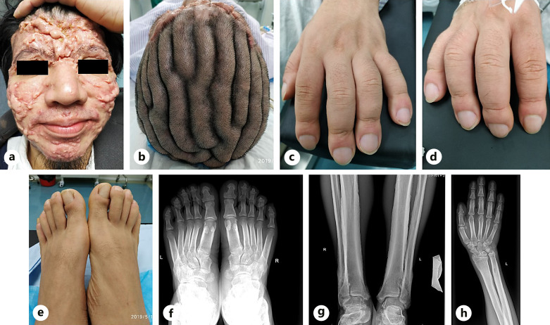 Comprehensive Treatment of a Rare Case of Complete Primary Pachydermoperiostosis with Large Facial Keloid Scars: A Case Report and Literature Review.
