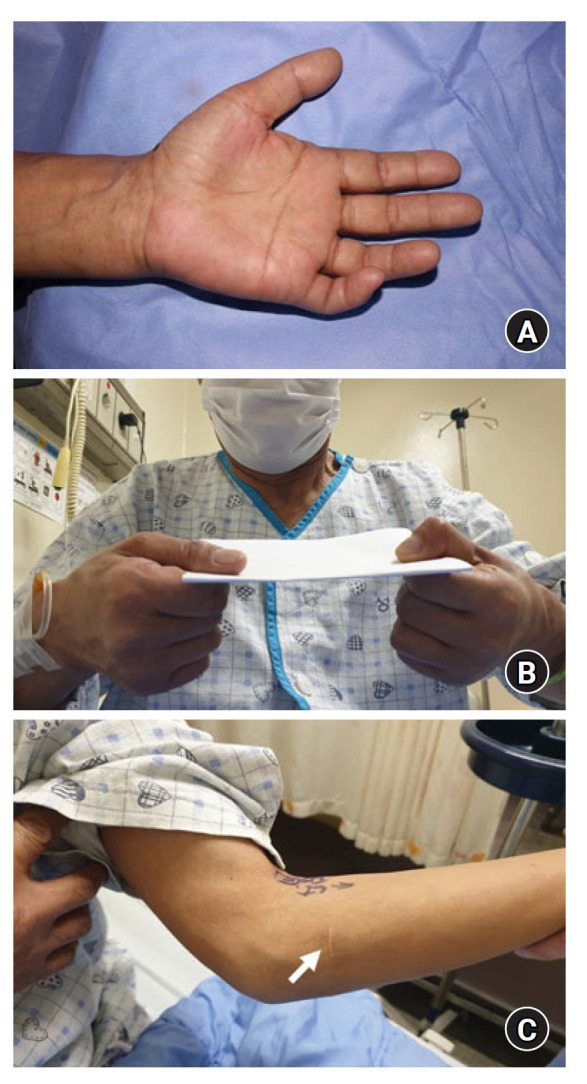 Cubital tunnel syndrome associated with previous ganglion cyst excision in the elbow: a case report.