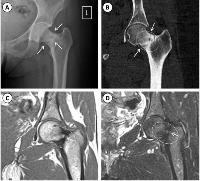 Fatigue Fracture of the Femoral Neck.