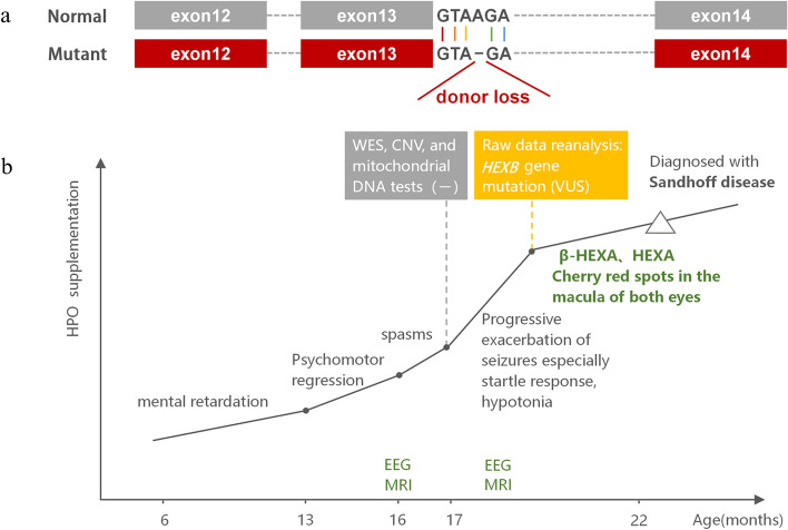 Genetic variant reanalysis reveals a case of Sandhoff disease with onset of infantile epileptic spasm syndrome.