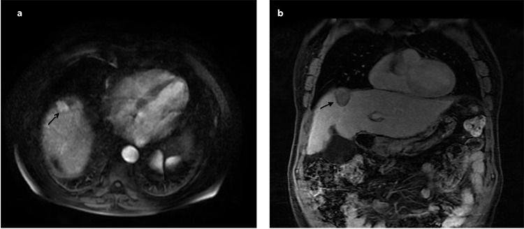 Effective and Safe Treatment of Risky Localized Liver Tumors Using Microwave Ablation in Patients with Comorbid Lung Diseases Unfit for Deep Anesthesia.