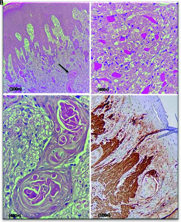 Oral Granular Cell Tumor: A Case Report with Emphasis on Pseudoepitheliomatous Hyperplasia in Oral Lesions.