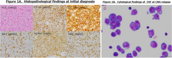 A case of successful CAR-T cell therapy for early isolated CNS recurrence of DLBCL with persistent CAR-T cells.