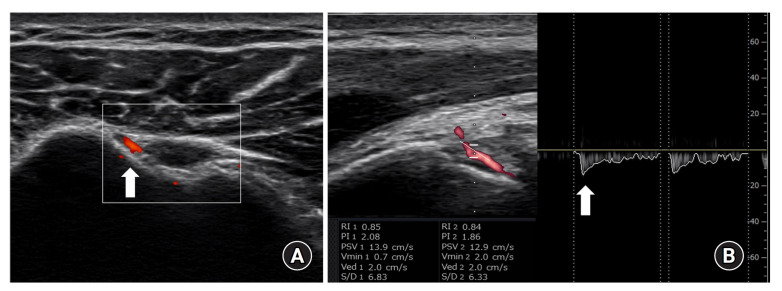 Blood flow velocity in the anterior humeral circumflex artery and tear size can predict synovitis severity in patients with rotator cuff tears.