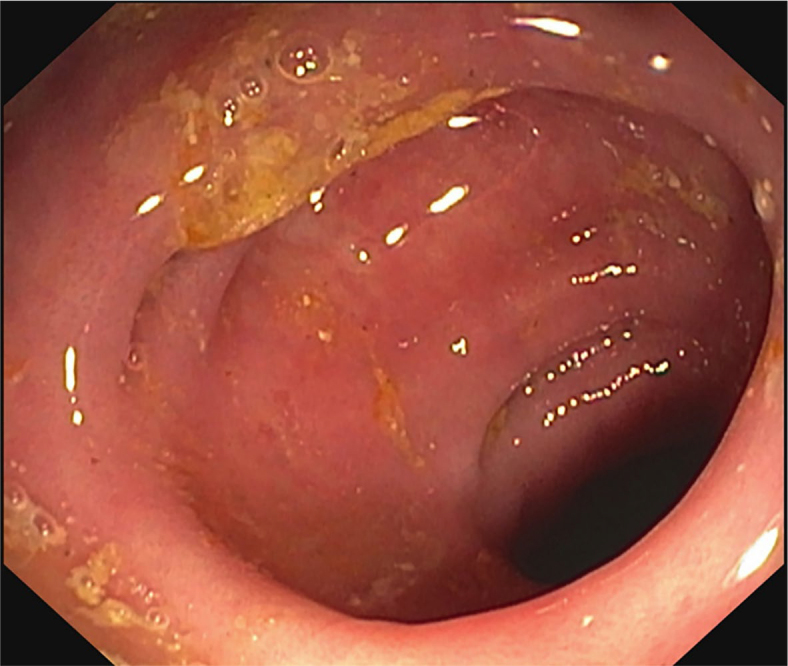 Colitis due to cancer treatment with immune check-point inhibitors - review of literature and presentation of clinical cases.