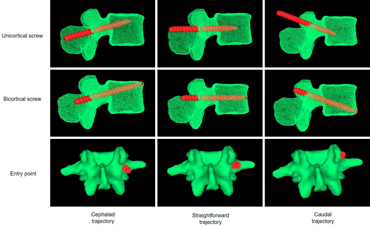 A Bicortical Pedicle Screw in the Cephalad Trajectory Is the Best Option for the Fixation of an Osteoporotic Vertebra: A Finite Element Study.