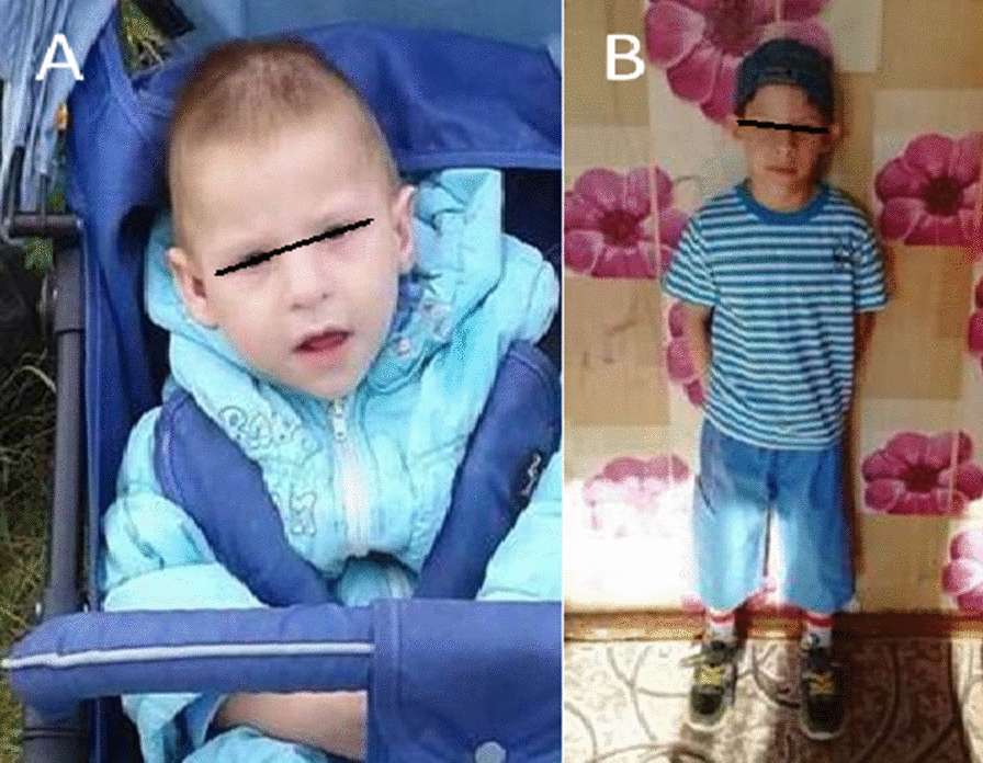 Family case of Potocki-Lupski syndrome.