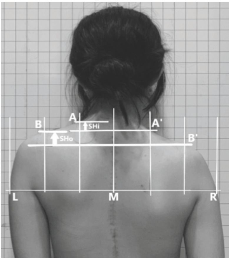 Shoulder and Neck Balance in Adolescent Idiopathic Scoliosis: Which Radiographic Indices are Reliable and Practical?