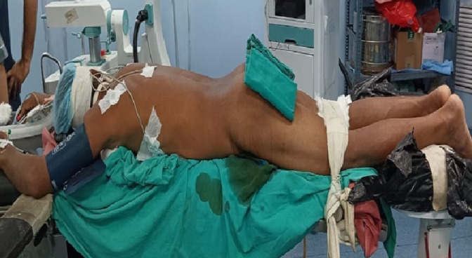 Prospective Comparative Analysis of Supine Versus Prone Percutaneous Nephrolithotomy in Patients with Complex Renal Stone Disease and Difficult Anatomy.