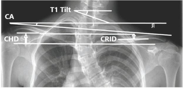 Shoulder and Neck Balance in Adolescent Idiopathic Scoliosis: Which Radiographic Indices are Reliable and Practical?