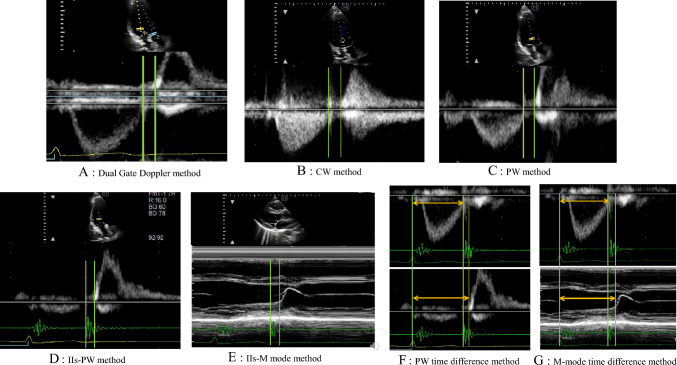 Reliable measurement methods for the isovolumic relaxation time: comparisons of dual gate Doppler and seven other methods.
