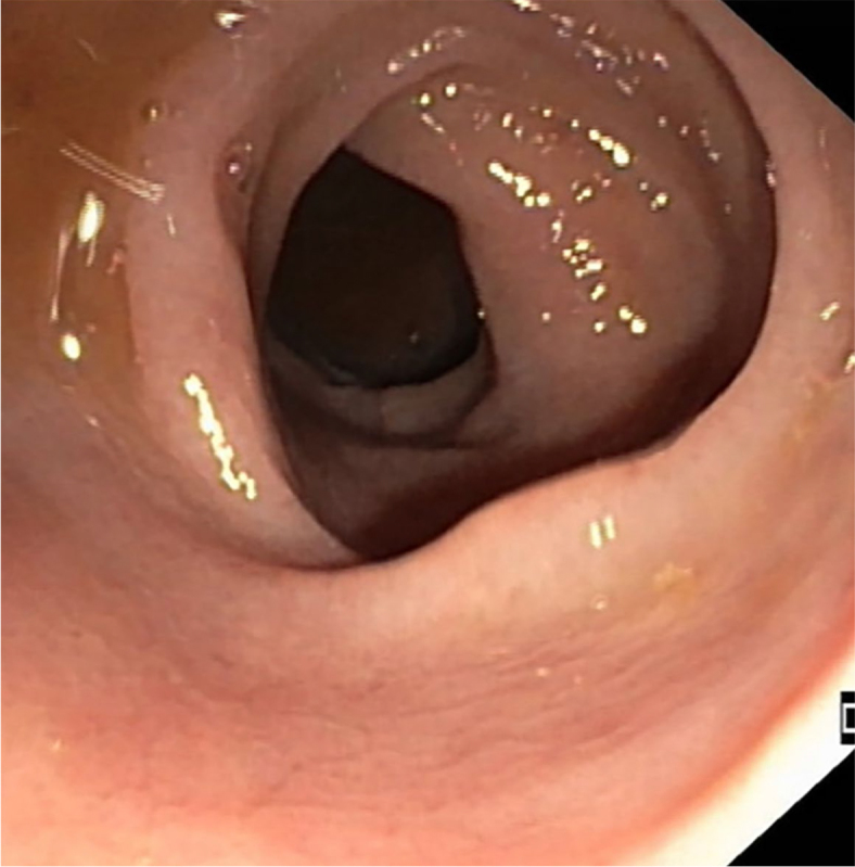 Colitis due to cancer treatment with immune check-point inhibitors - review of literature and presentation of clinical cases.