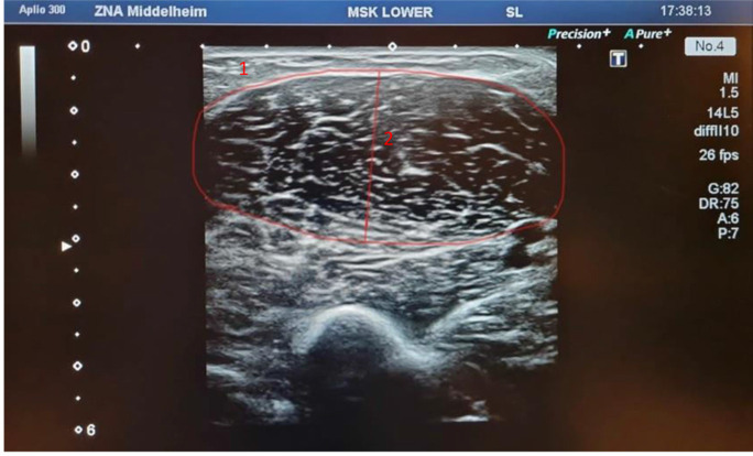 Relation Between Ultrasonographic Measurements of the Biceps Brachii and Total Muscle Mass in Older Hospitalized Persons: A Pilot Study.