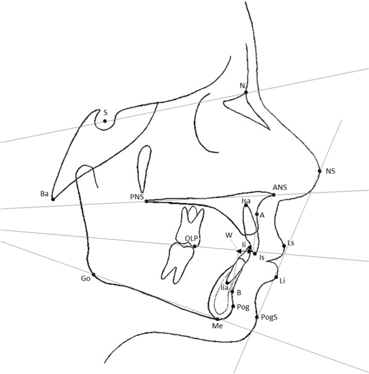 Effects of premolar extraction and orthodontic treatment in adolescents - a retrospective cephalometric study.