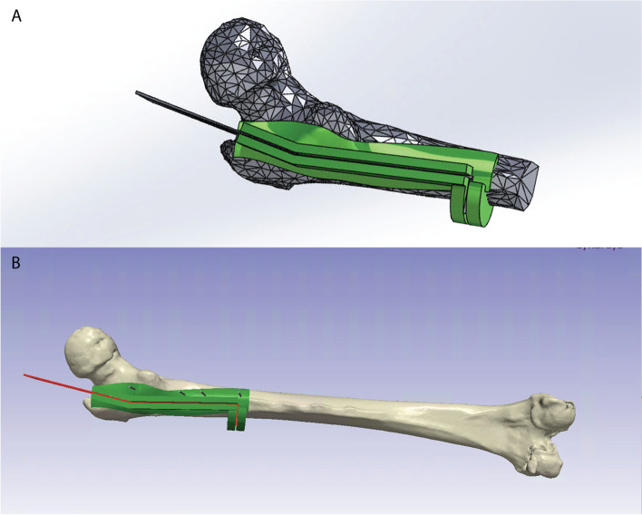 The feasibility of a novel 3D-Printed patient specific cutting guide for extended trochanteric osteotomies.