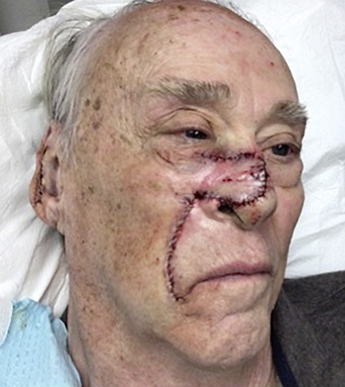 Repair of a Large Nasal Ala and Medial Cheek Defect: Case Report.