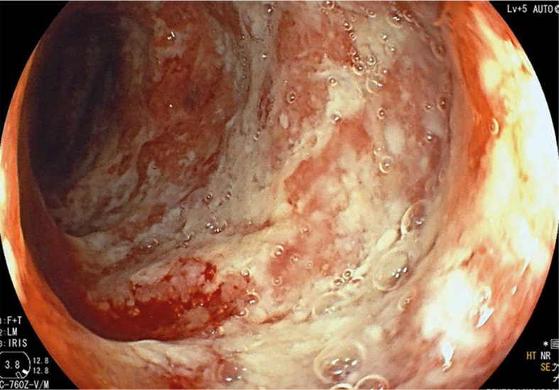 Colitis due to cancer treatment with immune check-point inhibitors - review of literature and presentation of clinical cases.