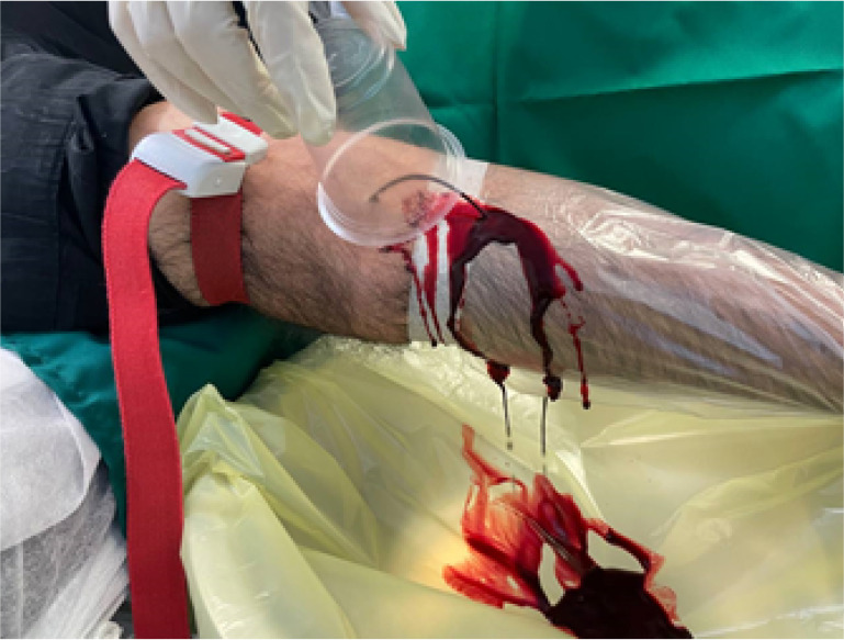 A Case Report of Prolonged Hemorrhage Following Traditional Phlebotomy (Fasd).