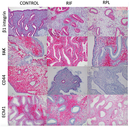 Evaluation of endometrial receptivity in recurrent pregnancy loss and recurrent implantation failure.