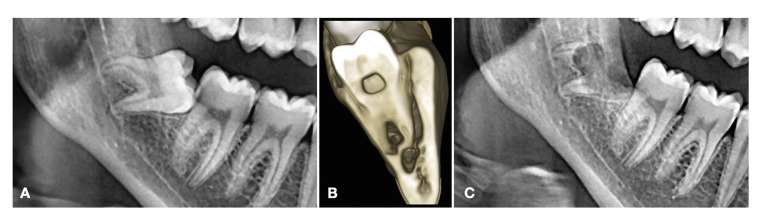 Coronectomy of impacted mandibular third molars: a clinical and radiological retrospective case series study with 2-9 years of follow-up.