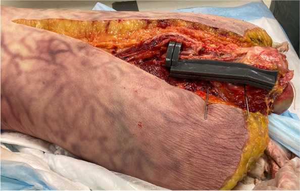 The feasibility of a novel 3D-Printed patient specific cutting guide for extended trochanteric osteotomies.