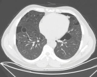 Birt-Hogg-Dubé syndrome with novel FLCN gene mutations and different clinical presentations: Case series.