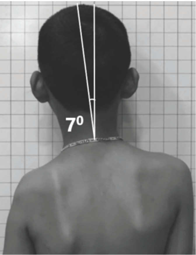 Shoulder and Neck Balance in Adolescent Idiopathic Scoliosis: Which Radiographic Indices are Reliable and Practical?