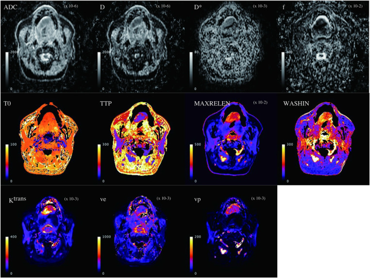 Correlation between diffusion-weighted image-derived parameters and dynamic contrast-enhanced magnetic resonance imaging-derived parameters in the orofacial region.