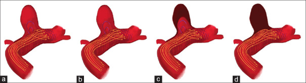 Periprocedural management of patients presenting for neurointerventional procedures using flow diverters for complex intracranial aneurysms: An anesthetist's perspective - A narrative review.
