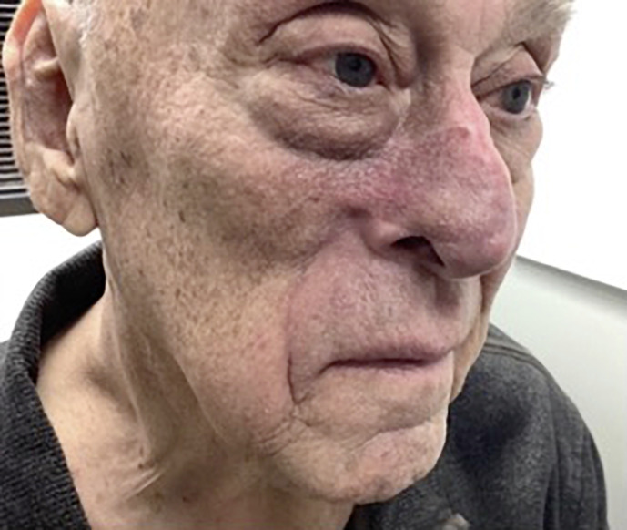 Repair of a Large Nasal Ala and Medial Cheek Defect: Case Report.